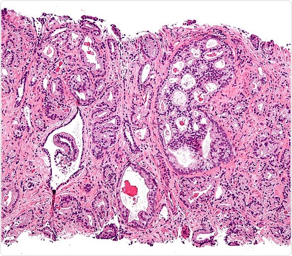 Micrograph showing prostatic acinar adenocarcinoma (the most common form of prostate cancer) Gleason pattern 4. H&E stain. Prostate currettings.
