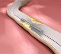 Sirolimus-eluting balloon emerges as a safe and effective option for coronary in-stent restenosis