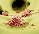Key protein found to guide melanoma cells during spread