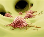 Researchers identify four hallmarks of cancer metastasis