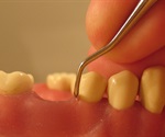 What is Periodontitis?