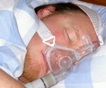 Sleep apnea may be commonly misdiagnosed with hypertension