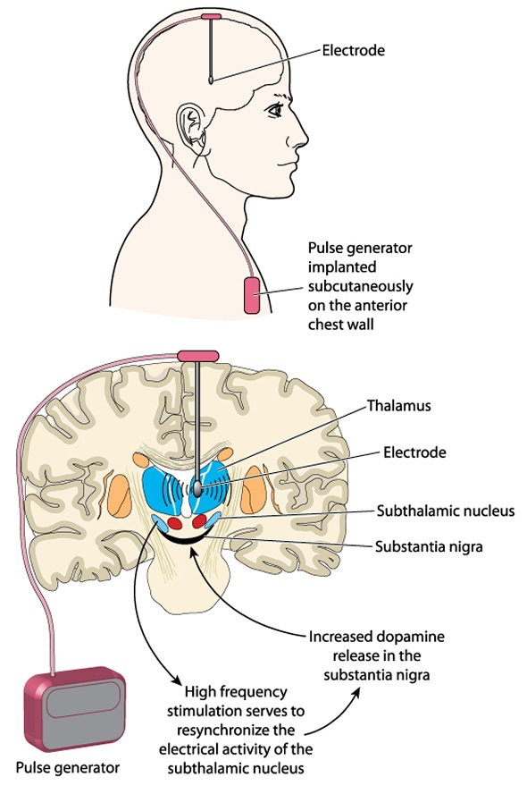 Deep brain stimulation using an implanted pulse generator