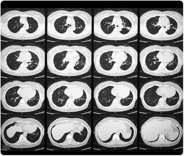 HRCT Scan of Chest in a 42 years old woman with Nephrotic syndrome - Image Copyright: Santibhavank P / Shutterstock