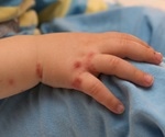 Eczema in babies