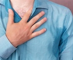 Broader range of treatments for excessive sweating disorder, Mayo Clinic Proceedings says