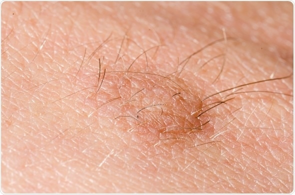 Hairy skin tag on a persons skin close up