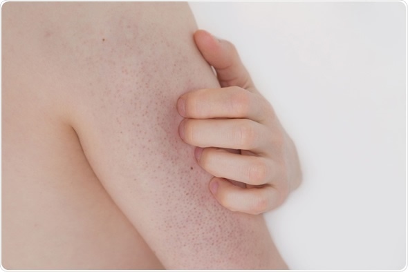 Young man with Keratosis pilaris on his upper arm
