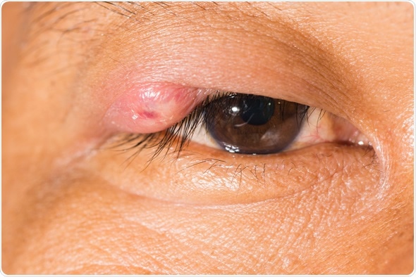 Close up of the stye during eye examination. Image Copyright: ARZTSAMUI / Shutterstock