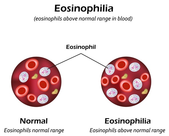 Eosinophils above normal range in blood. Eosinophilia. Infographics. Vector illustration. Image Copyright: Timonina / Shutterstock