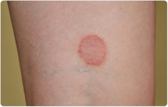Lichen ruber planus on the leg of young woman - Image Copyright: Elena Stepanova / Shutterstock