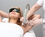 What is Laser Hair Removal?