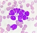 Two ongoing studies show promise of pivekimab sunirine in treating aggressive blood cancers