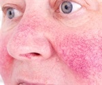 Rosacea and Small Intestinal Bacterial Overgrowth (SIBO)