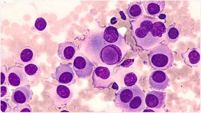 Fine needle aspirate cytology of metastatic melanoma, with large malignant cells. In the center of this photomicrograph is an