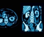 Tests for Ureteric Calculi: Radiograph, CT and Ultrasound