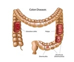 Colorectal Surgery