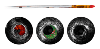 Eagle Eye Platinum ST Digital IVUS Catheter from Philips Healthcare