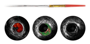Eagle Eye Platinum Digital IVUS Catheter from Philips Healthcare