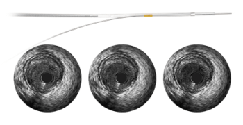 Philips Healthcare's Revolution Rotational IVUS Imaging Catheter