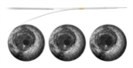 Philips Healthcare's Revolution Rotational IVUS Imaging Catheter