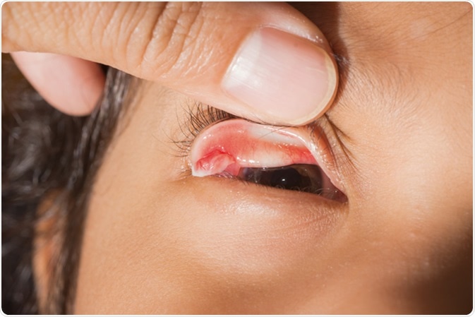 Close up of upper eyelid pyogenic granuloma during eye examination - Image Credit: ARZTSAMUI / Shutterstock