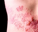 Shingles raises the risk for heart attack and stroke