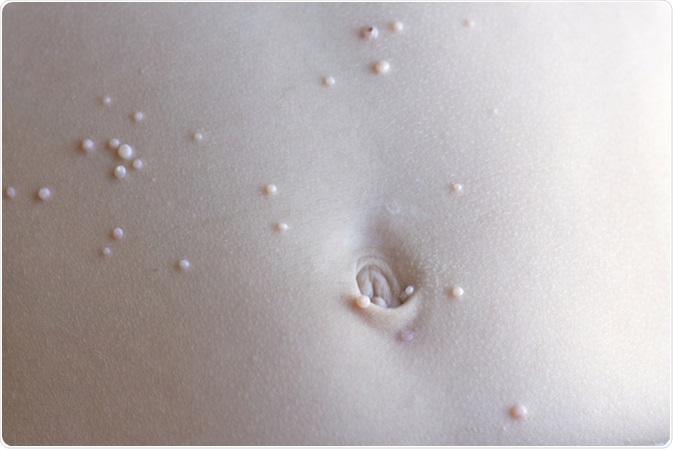 Molluscum contagiosum. Image Credit: Jarrod Erbe / Shutterstock