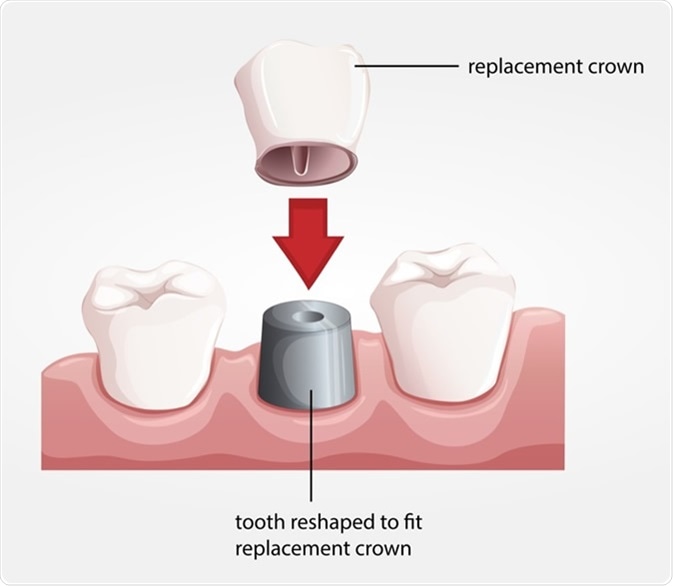 Illustration of a dental crown procedure. Image Credit: BlueRingMedia / Shutterstock
