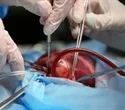 Researchers successfully perform coronary artery bypass without cutting the chest wall