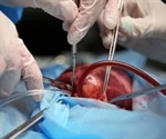 Researchers successfully perform coronary artery bypass without cutting the chest wall
