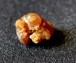 Kidney Stone Research