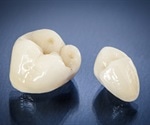 Procedure for Dental Crowns