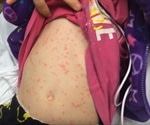 Fifth Disease Signs and Symptoms