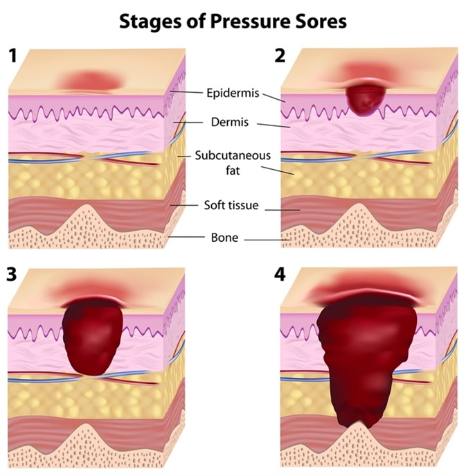 Stages of pressure sores. Image Credit: Alila Medical Media / Shutterstock