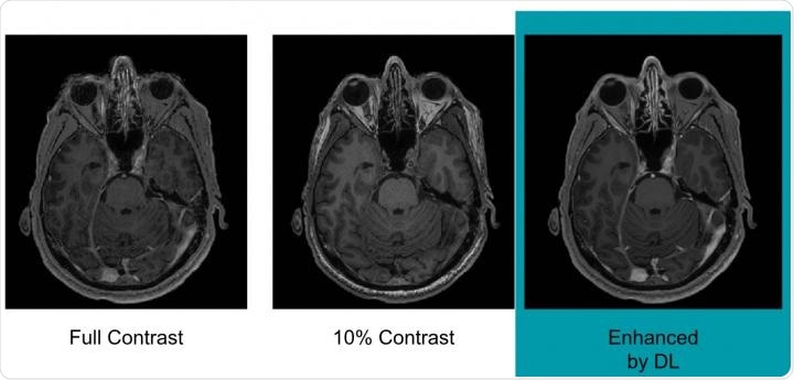 Example of full-dose, 10 percent low-dose and algorithm-enhanced low-dose - Radiological Society of North America