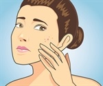 Acne: Preventing and Reducing Scarring