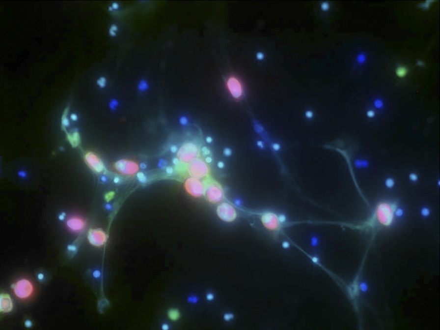 Ovarian cancer cells (red) can become trapped in sticky webs of DNA (green) released by immune cells known as neutrophils. - Lee et al., 2018