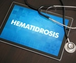 Hematidrosis Causes
