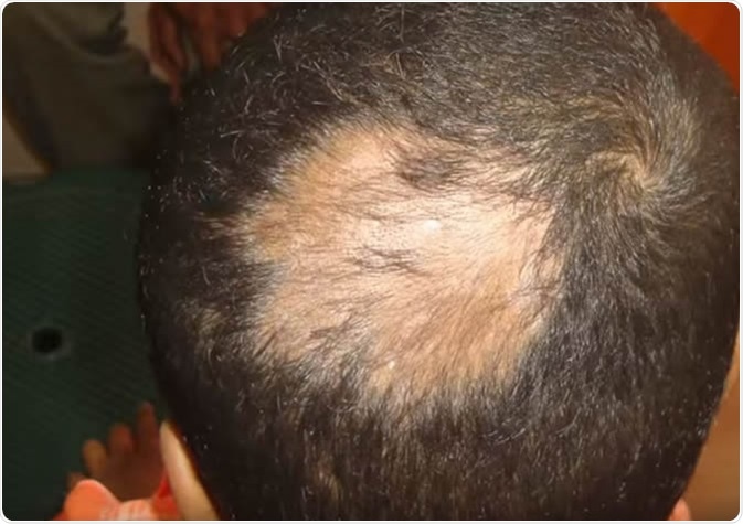 Folliculitis Decalvans. Image Credit: Ravi Clinic / Shutterstock