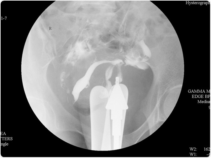 Hysterosalpingography (HSG) is a fluoroscopic X-ray study of a woman