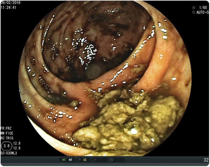 Upper Gastrointestinal Endoscopy,Esophageal cancer. Image Credit: Whitetherock Photo / Shutterstock