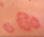 Nummular Dermatitis Symptoms and Diagnosis