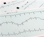 Northwestern scientists create new genetic risk score to improve prediction of arrhythmia