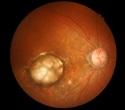 Research breakthrough could provide a new, non-invasive way to assess retinal health