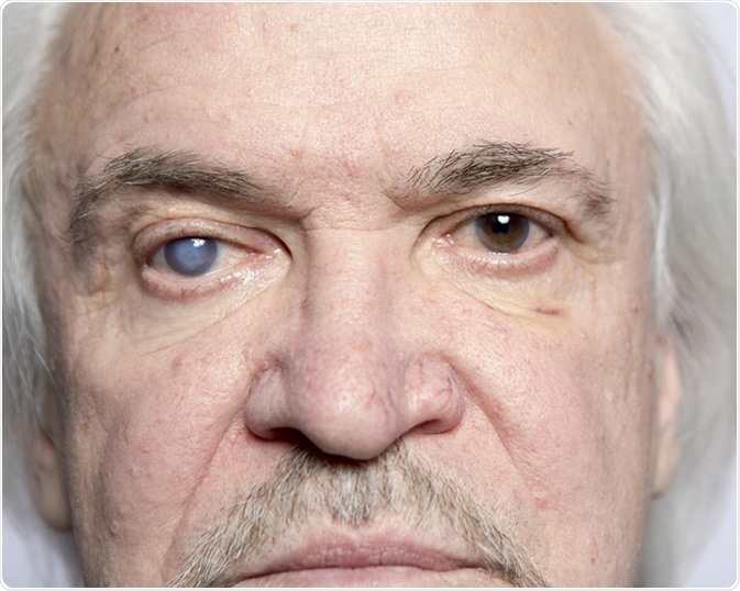 Patients with cataract and glaucoma. Image Credit: SERGEI PRIMAKOV / Shutterstock