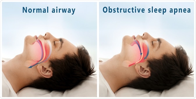 Diagram showing normal airway versus OSA airway of man during sleep - By Africa Studio