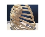 Stratasys advanced FDM 3D printing helps Biodonostia to improve treatment for thoracic wall tumors