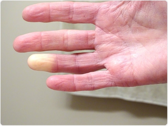 Adult hand with Raynaud