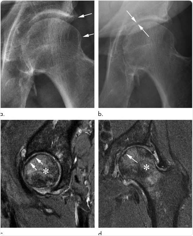 Rapid progressive osteoarthritis joint space loss (type 1) and subchondral insufficiency fracture in a 53-year-old man who presented with hip pain. (a) Anteroposterior left hip radiograph shows mild osteophytic changes (arrows) and no joint space loss. This patient was referred for intra-articular corticosteroid injection. (b) Seven weeks after injection, he returned with worsening hip pain. Repeat anteroposterior left hip radiograph shows accelerated loss of joint space (arrows). (c) Sagittal intermediate-weighted fat-suppressed MRI obtained at the same time as b shows a linear subchondral hypointensity representing subchondral insufficiency fracture of the anterior superior femoral head with subtle flattening of the overlying articular surface (arrows). Extensive bone marrow edema extends to the femoral neck. (d) Corresponding coronal intermediate-weighted fat-suppressed MRI enables us to confirm the presence of a subchondral insufficiency fracture (arrow) and depicts the true extent of bone marrow edema. Image Credit: Radiological Society of North America
